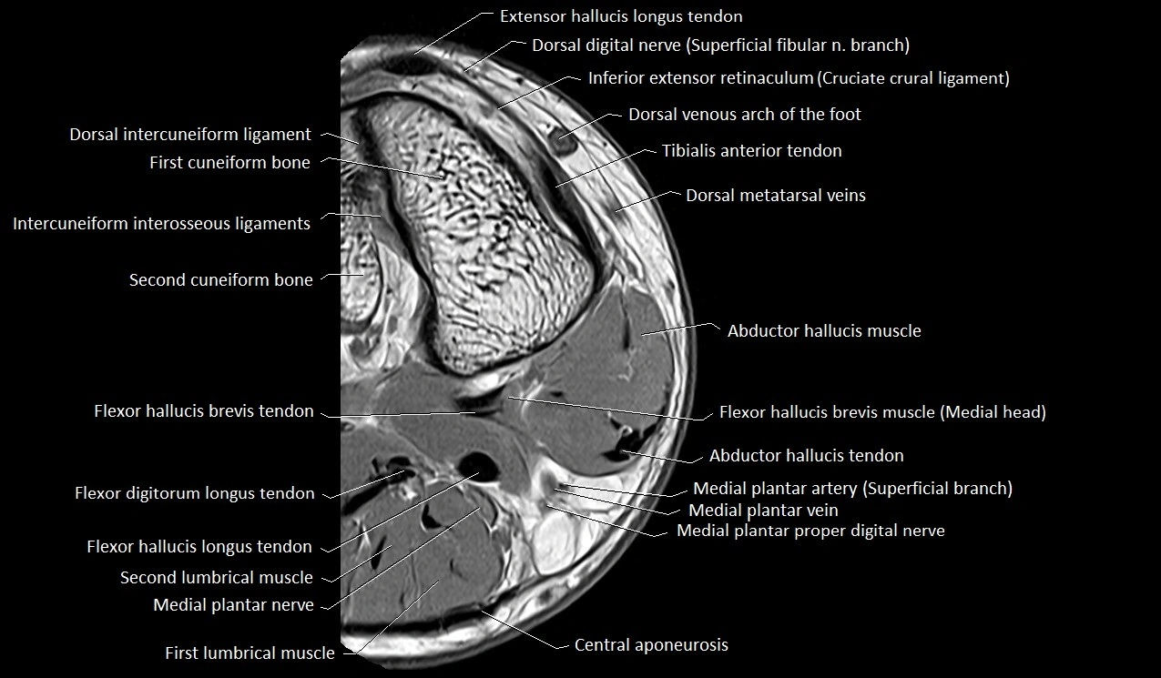 Great toe (hallux) axial microanatomy 3T MRI image 49.webp